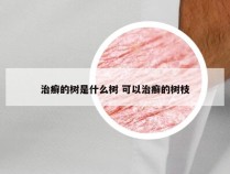 治癣的树是什么树 可以治癣的树枝