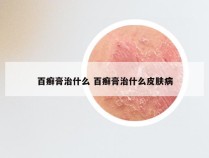 百癣膏治什么 百癣膏治什么皮肤病