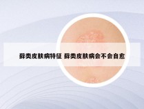 藓类皮肤病特征 藓类皮肤病会不会自愈