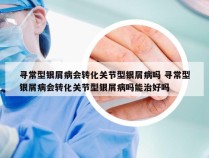 寻常型银屑病会转化关节型银屑病吗 寻常型银屑病会转化关节型银屑病吗能治好吗