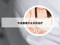 牛皮癣用什么中药治疗