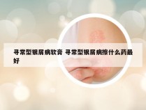 寻常型银屑病软膏 寻常型银屑病擦什么药最好