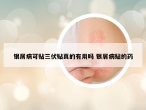 银屑病可贴三伏贴真的有用吗 银屑病贴的药