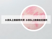 小孩头上脓藓照片照 小孩头上脓癣痊愈图片