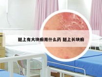 腿上有大块癣用什么药 腿上长块癣