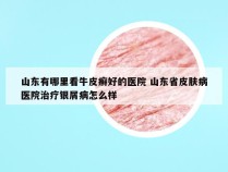 山东有哪里看牛皮癣好的医院 山东省皮肤病医院治疗银屑病怎么样