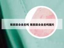 银屑藓会自愈吗 银屑藓会自愈吗图片