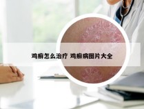 鸡癣怎么治疗 鸡癣病图片大全