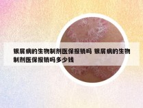 银屑病的生物制剂医保报销吗 银屑病的生物制剂医保报销吗多少钱