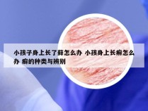 小孩子身上长了藓怎么办 小孩身上长癣怎么办 癣的种类与辨别