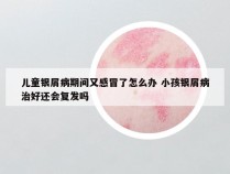 儿童银屑病期间又感冒了怎么办 小孩银屑病治好还会复发吗