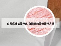 白殿疯症状是什么 白殿疯的最佳治疗方法