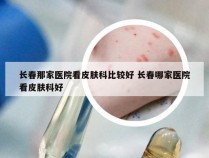 长春那家医院看皮肤科比较好 长春哪家医院看皮肤科好