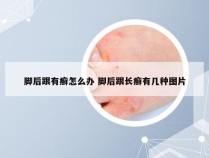 脚后跟有癣怎么办 脚后跟长癣有几种图片