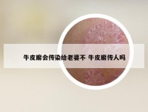 牛皮廨会传染给老婆不 牛皮廨传人吗