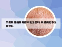 只要银屑病有关都不能治愈吗 银屑病能不治自愈吗