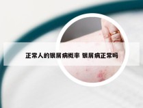 正常人的银屑病概率 银屑病正常吗