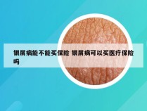 银屑病能不能买保险 银屑病可以买医疗保险吗