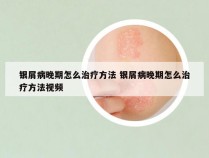 银屑病晚期怎么治疗方法 银屑病晚期怎么治疗方法视频