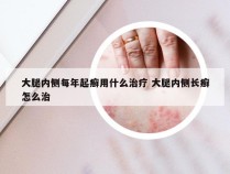 大腿内侧每年起癣用什么治疗 大腿内侧长癣怎么治