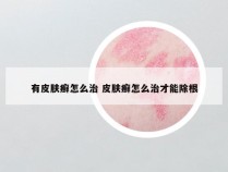 有皮肤癣怎么治 皮肤癣怎么治才能除根