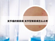 关节痛的银屑病 关节型银屑病怎么止疼