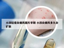 小孩轻度白癞风图片早期 小孩白癞风多久会扩散