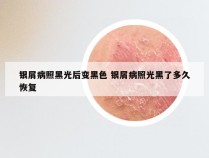 银屑病照黑光后变黑色 银屑病照光黑了多久恢复