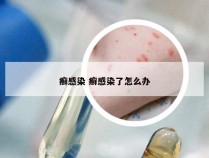 癣感染 癣感染了怎么办