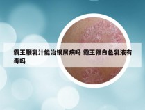 霸王鞭乳汁能治银屑病吗 霸王鞭白色乳液有毒吗