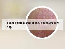 儿子身上好像起了癣 儿子身上好像起了癣怎么办