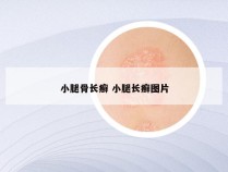 小腿骨长癣 小腿长癣图片