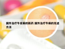 国外治疗牛皮癣的新药 国外治疗牛癣的先进方法