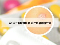 nbuvb治疗银屑病 治疗银屑病特效药