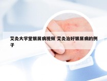 艾灸大学堂银屑病视频 艾灸治好银屑病的例子