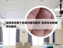 信阳市区哪个皮肤科医院最好 信阳市皮肤病专科医院