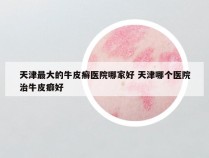 天津最大的牛皮癣医院哪家好 天津哪个医院治牛皮癖好