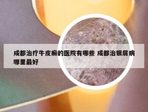 成都治疗牛皮癣的医院有哪些 成都治银屑病哪里最好