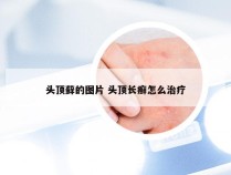 头顶藓的图片 头顶长癣怎么治疗