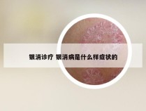 银消诊疗 银消病是什么样症状的