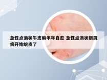 急性点滴状牛皮癣半年自愈 急性点滴状银屑病开始蜕皮了