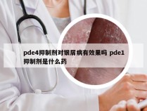 pde4抑制剂对银屑病有效果吗 pde1抑制剂是什么药