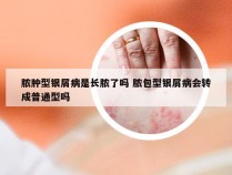 脓肿型银屑病是长脓了吗 脓包型银屑病会转成普通型吗