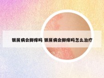 银屑病会脚痒吗 银屑病会脚痒吗怎么治疗