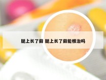 腿上长了藓 腿上长了藓能根治吗