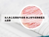 女人身上出类似牛皮癣 身上有牛皮肤癣是怎么回事