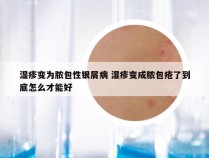 湿疹变为脓包性银屑病 湿疹变成脓包疮了到底怎么才能好