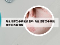 角化增厚型手癣能自愈吗 角化增厚型手癣能自愈吗怎么治疗