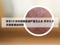 怀孕3个月时得银屑病严重怎么办 怀孕几个月银屑病会好转