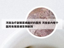 河南治疗副银屑病最好的医院 河南省内哪个医院有银屑病生物制剂